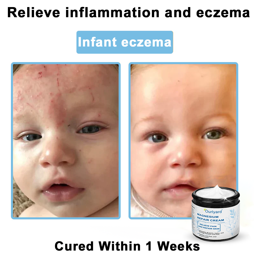 šā
Mayo Clinic Official: Magnesium skin repair cream (Eczema and Psoriasis Relief, Skin Repair, Even Tone, Acne and Dark Spot Treatment, Wart and Mole Removal)