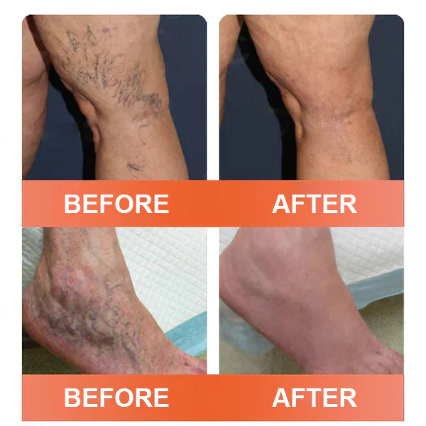【Last Day Promotion 80% OFF】FDA Official: Seurico™ Vein Ease Microneedle Care Patch(For Spider Veins, Varicose Veins, Swelling & Leg Fatigue)