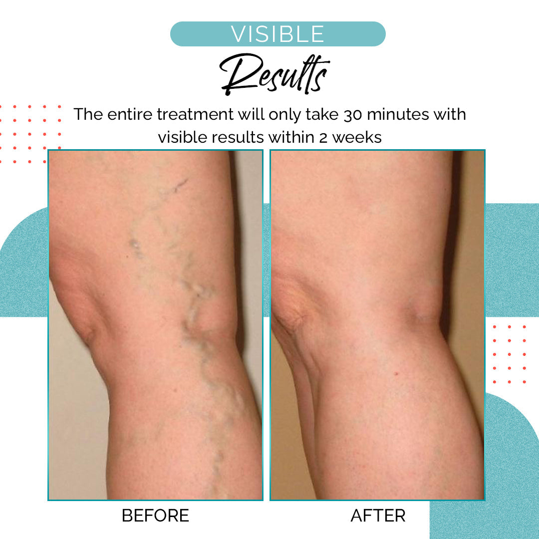 VariLuxe Varicose Veins Blue Light Treatment Pen