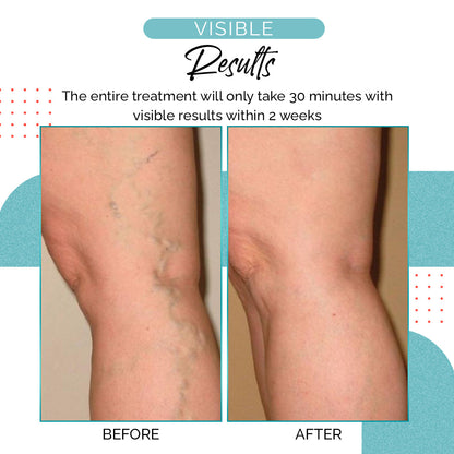 VariLuxe Varicose Veins Blue Light Treatment Pen