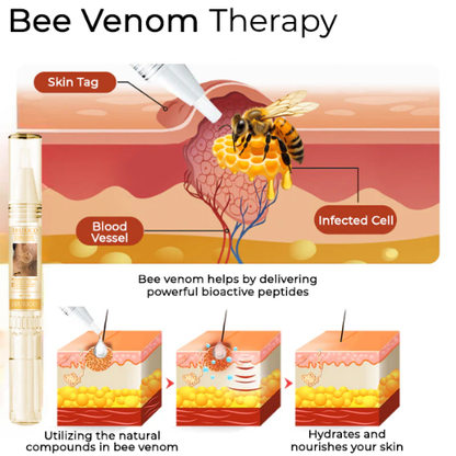 🐝Last Day Promotion 49% OFF Seurico™ Bee Venom Wart Removal Pen