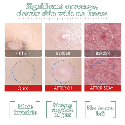 Medical-Grade Acne Patch ✨