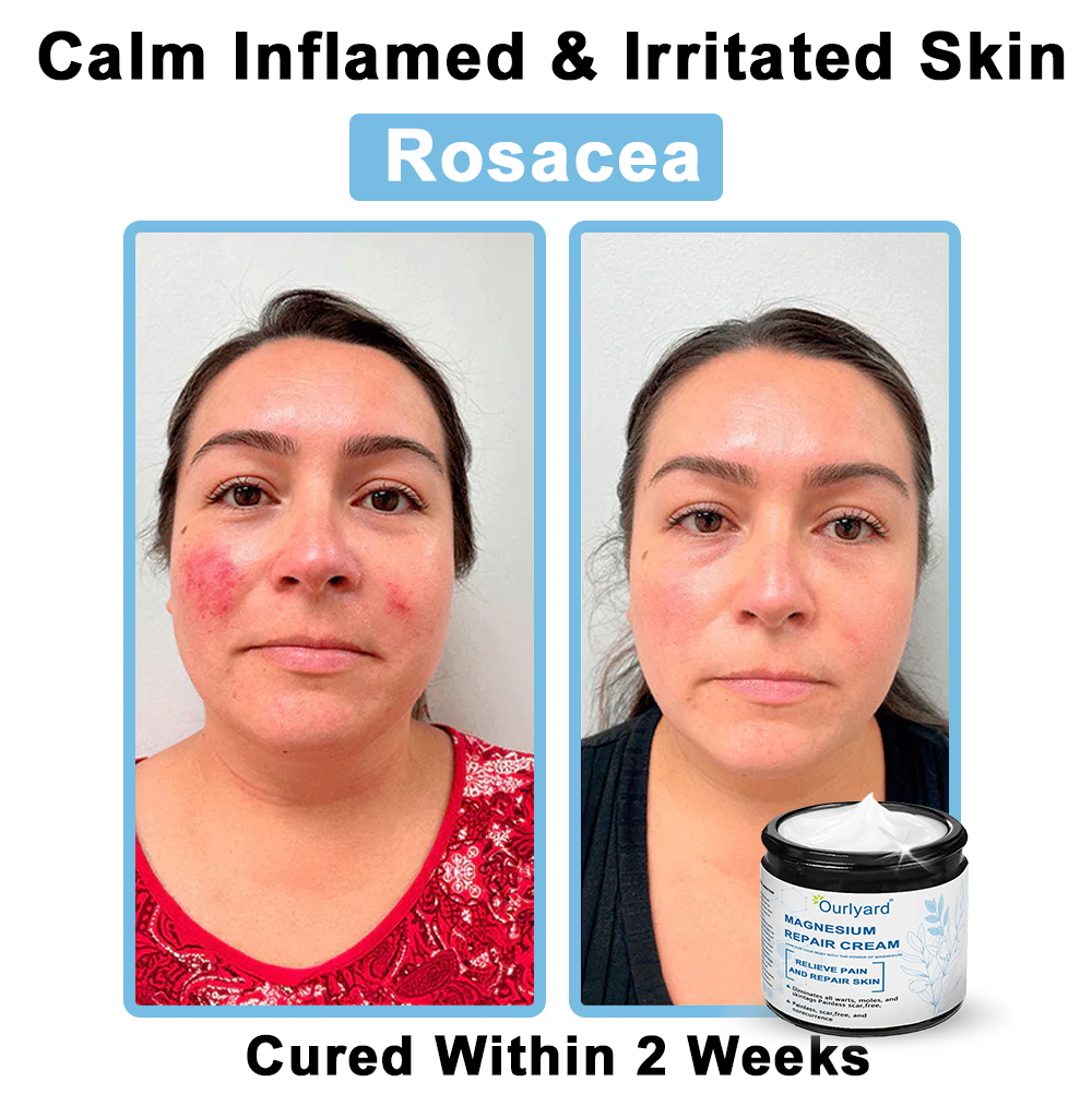 🏆✅Mayo Clinic Official: Magnesium skin repair cream (Eczema and Psoriasis Relief, Skin Repair, Even Tone, Acne and Dark Spot Treatment, Wart and Mole Removal)