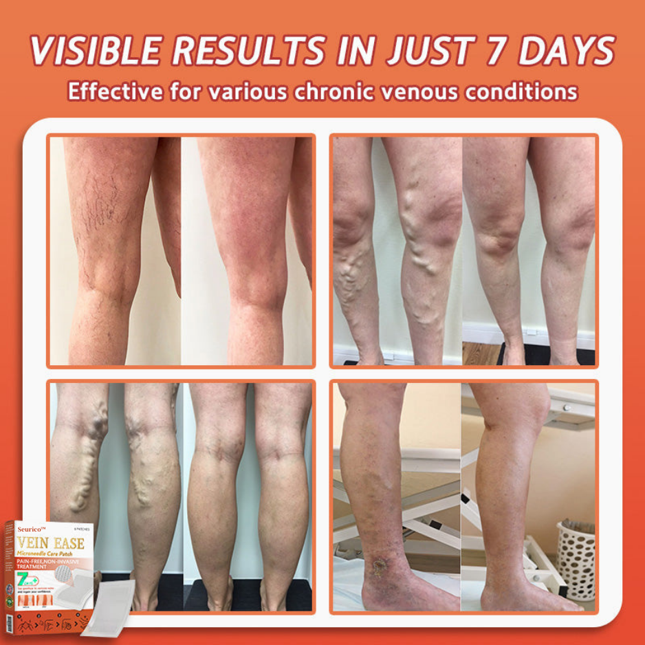 【Last Day Promotion 80% OFF】FDA Official: Seurico™ Vein Ease Microneedle Care Patch(For Spider Veins, Varicose Veins, Swelling & Leg Fatigue)