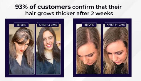 🌿 Odeiun™ Natural Hair Regrowth Spray – 70% OFF Ends Tonight! 🔥