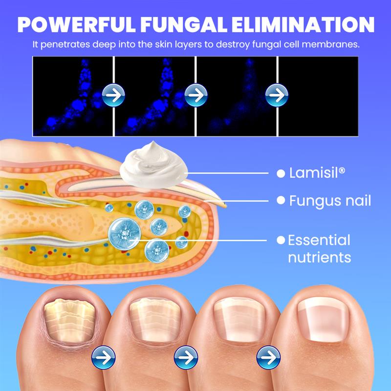 🦶Lamisill™ 1 Week Athlete's Foot Treatment, Antifungal Cream with Terbinafine Hydrochloride 1%, Fast Symptom Relief & Prevents Recurrence