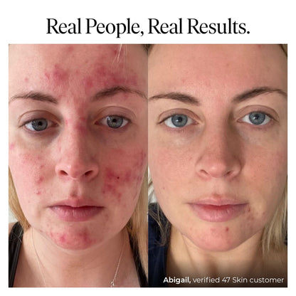 47 SKIN Aura™ Anti-Blemish & Scar Repair Serum